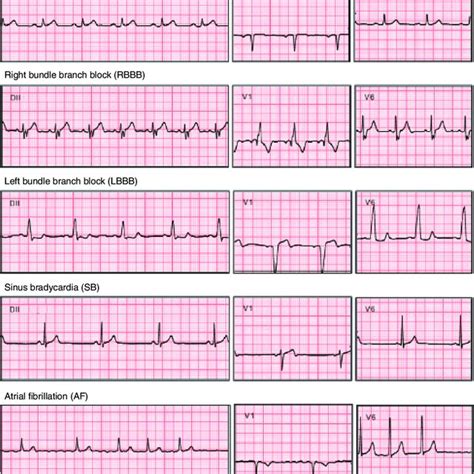 ekg readings abnormal|Iba pa.